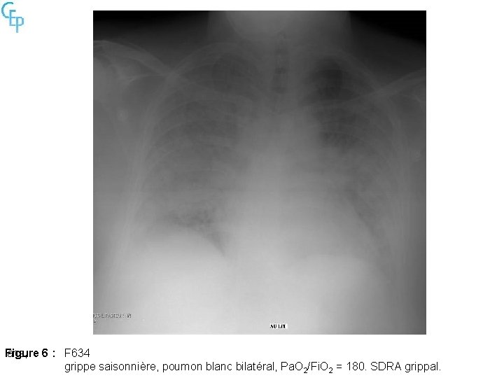 Figure 6 : ans, F 634 grippe saisonnière, poumon blanc bilatéral, Pa. O 2/Fi.