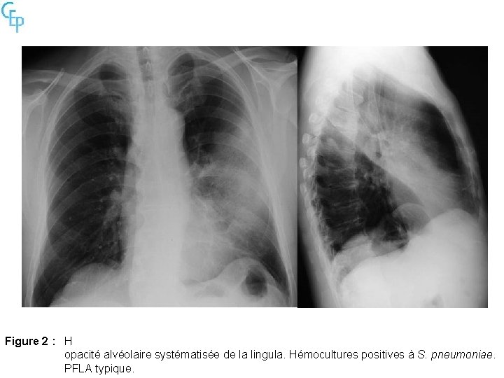 Figure 2 : H opacité alvéolaire systématisée de la lingula. Hémocultures positives à S.