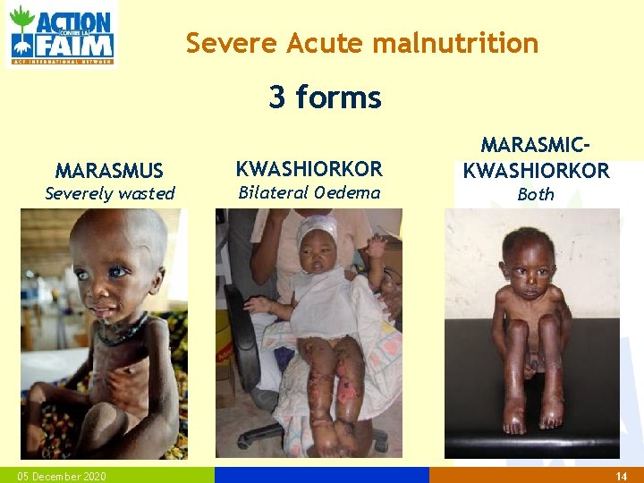 Severe Acute malnutrition 3 forms MARASMUS Severely wasted 05 December 2020 KWASHIORKOR Bilateral Oedema