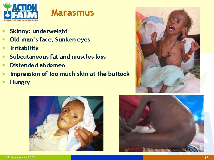 Marasmus § § § § Skinny: underweight Old man’s face, Sunken eyes Irritability Subcutaneous
