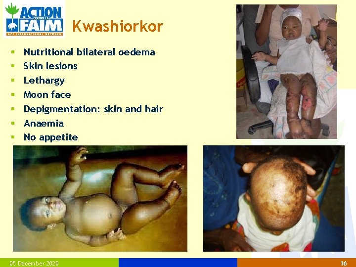 Kwashiorkor § § § § Nutritional bilateral oedema Skin lesions Lethargy Moon face Depigmentation: