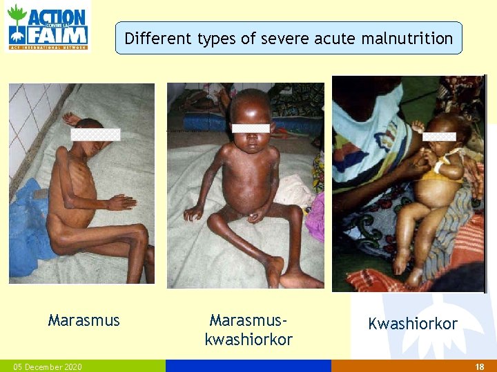 Different types of severe acute malnutrition Marasmus 05 December 2020 Marasmuskwashiorkor Kwashiorkor 18 