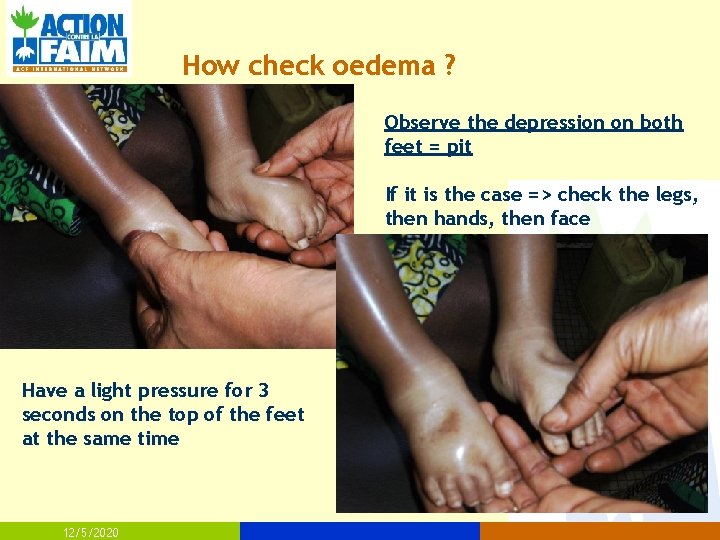 How check oedema ? Observe the depression on both feet = pit If it