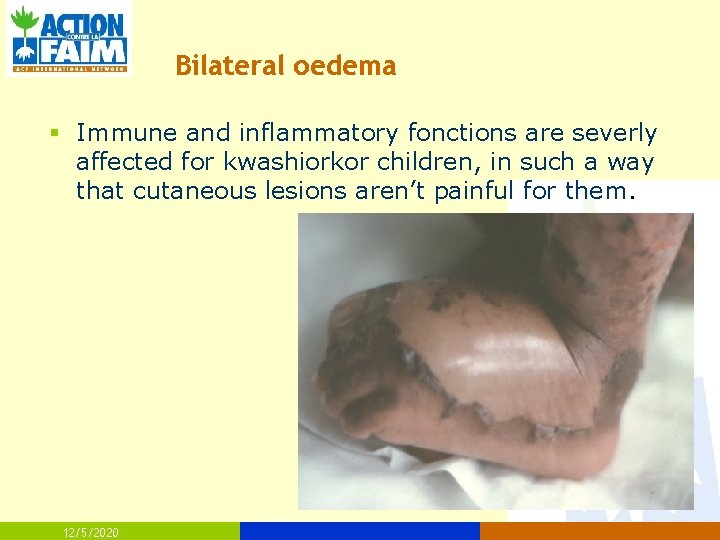 Bilateral oedema § Immune and inflammatory fonctions are severly affected for kwashiorkor children, in
