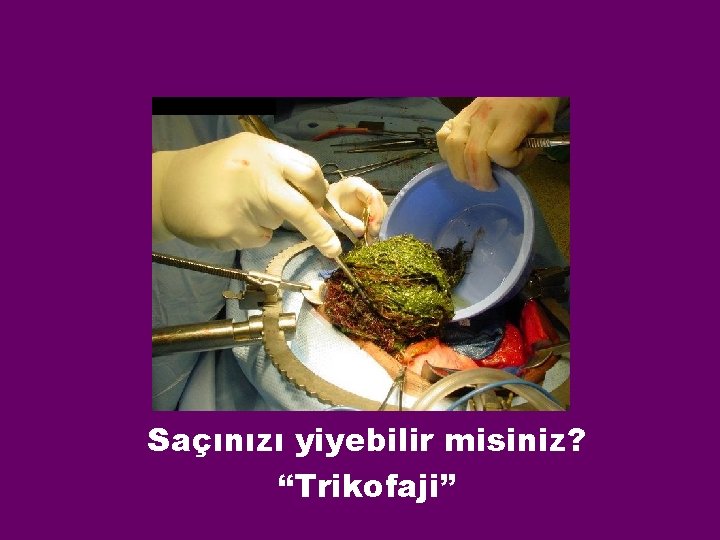 Saçınızı yiyebilir misiniz? “Trikofaji” 