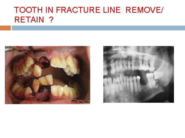 TOOTH IN FRACTURE LINE REMOVE/ RETAIN ? 