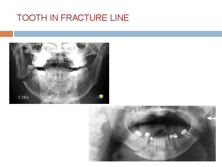 TOOTH IN FRACTURE LINE 
