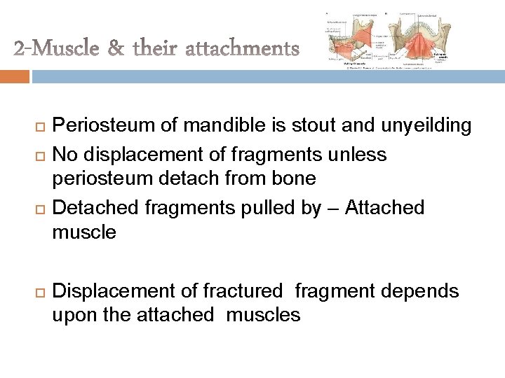  Periosteum of mandible is stout and unyeilding No displacement of fragments unless periosteum