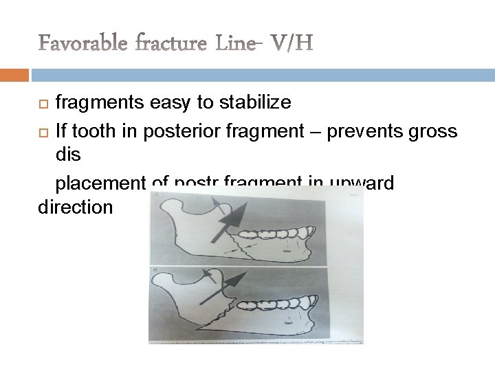 fragments easy to stabilize If tooth in posterior fragment – prevents gross dis placement