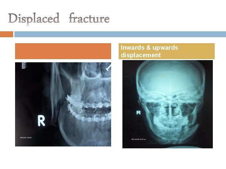 Inwards & upwards displacement 