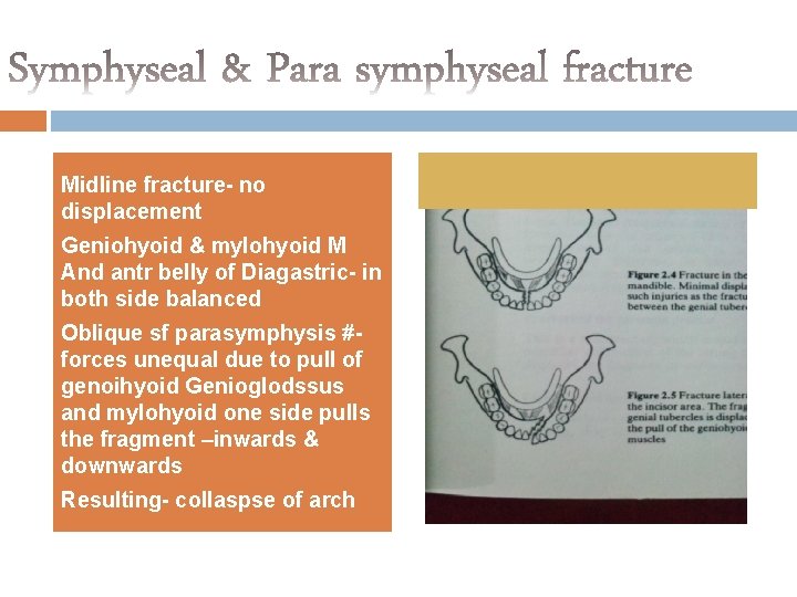 Midline fracture- no displacement Geniohyoid & mylohyoid M And antr belly of Diagastric- in