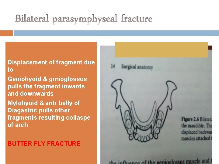 Displacement of fragment due to Geniohyoid & grnioglossus pulls the fragment inwards and downwards