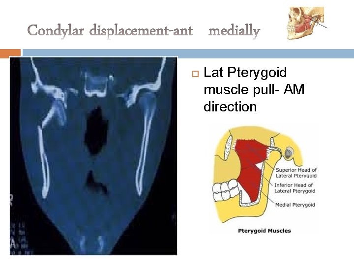  Lat Pterygoid muscle pull- AM direction 