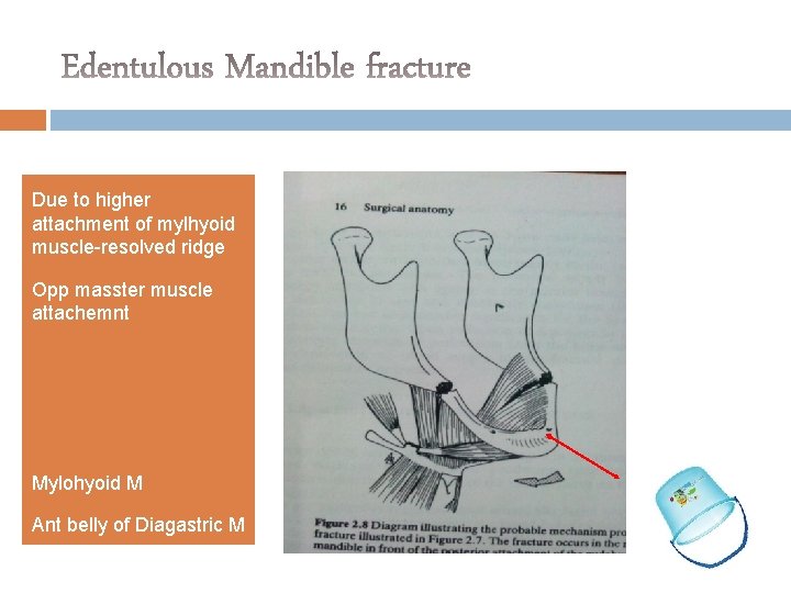 Due to higher attachment of mylhyoid muscle-resolved ridge Opp masster muscle attachemnt Mylohyoid M