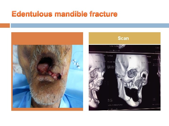 Edentulous mandible fracture Scan 