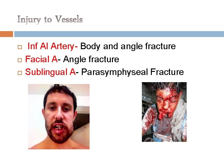  Inf Al Artery- Body and angle fracture Facial A- Angle fracture Sublingual A-