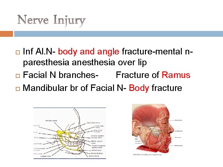  Inf Al. N- body and angle fracture-mental nparesthesia anesthesia over lip Facial N