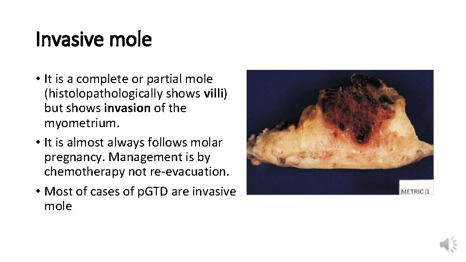 Invasive mole • It is a complete or partial mole (histolopathologically shows villi) but