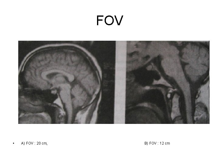 FOV • A) FOV : 20 cm, B) FOV : 12 cm 