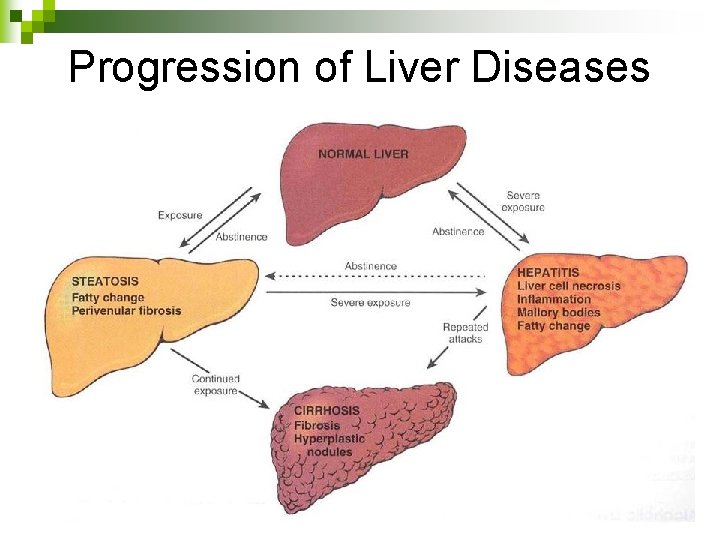 Progression of Liver Diseases 