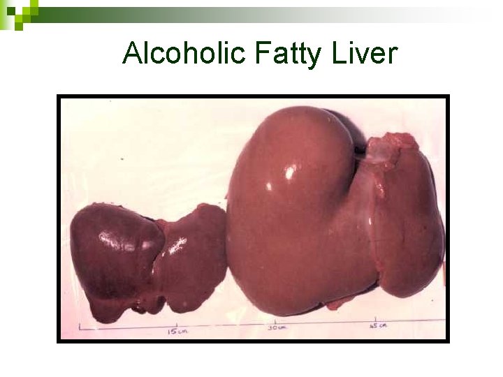 Alcoholic Fatty Liver 