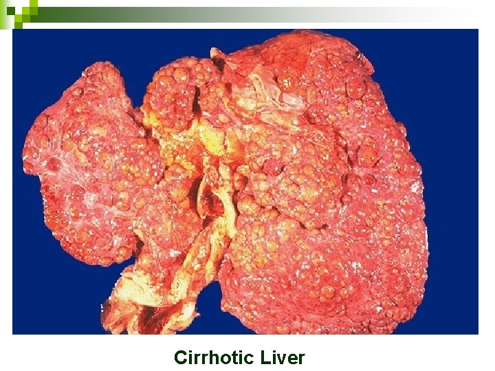 Cirrhotic Liver 