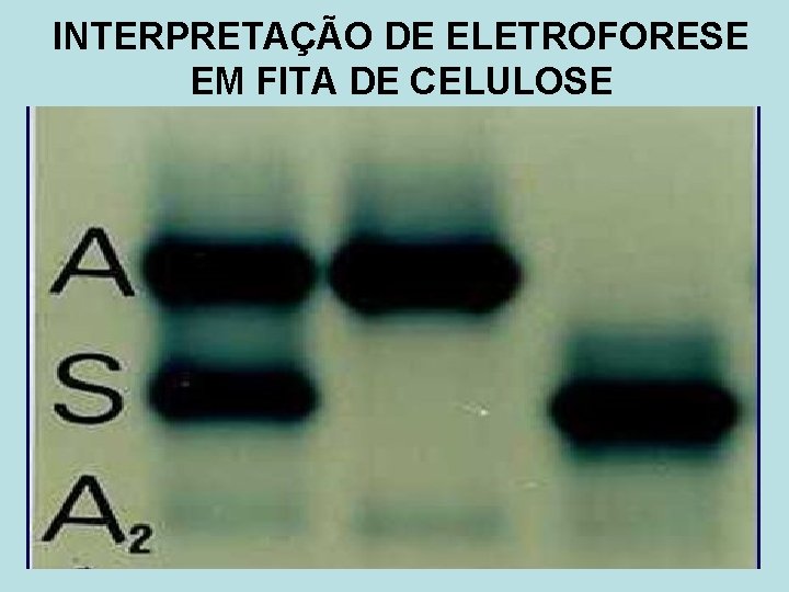 INTERPRETAÇÃO DE ELETROFORESE EM FITA DE CELULOSE 
