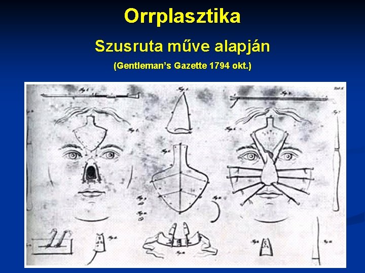 Orrplasztika Szusruta műve alapján (Gentleman’s Gazette 1794 okt. ) 