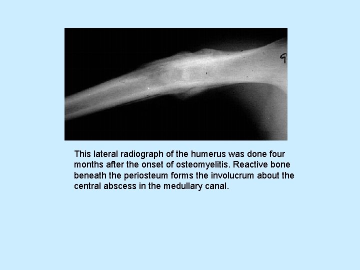 This lateral radiograph of the humerus was done four months after the onset of