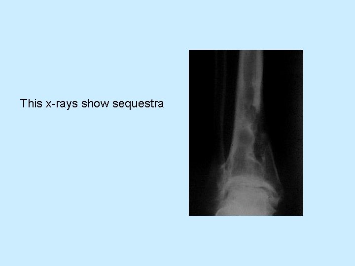 This x-rays show sequestra 