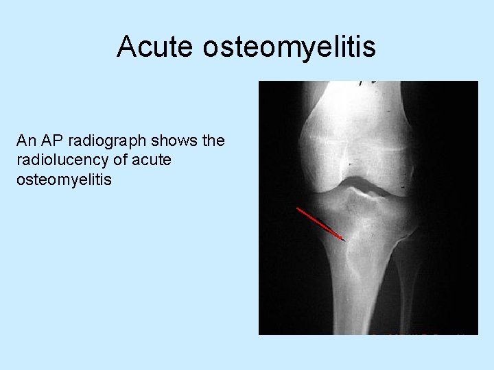 Acute osteomyelitis An AP radiograph shows the radiolucency of acute osteomyelitis 