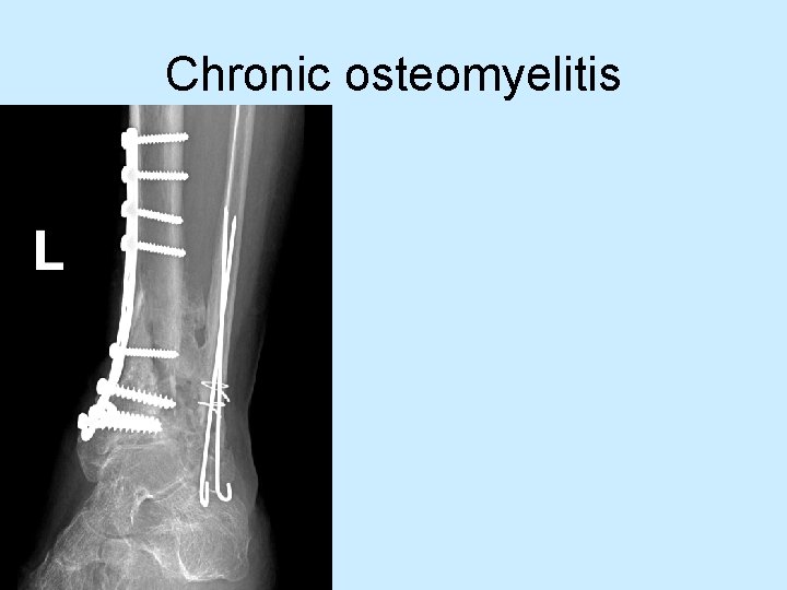 Chronic osteomyelitis 