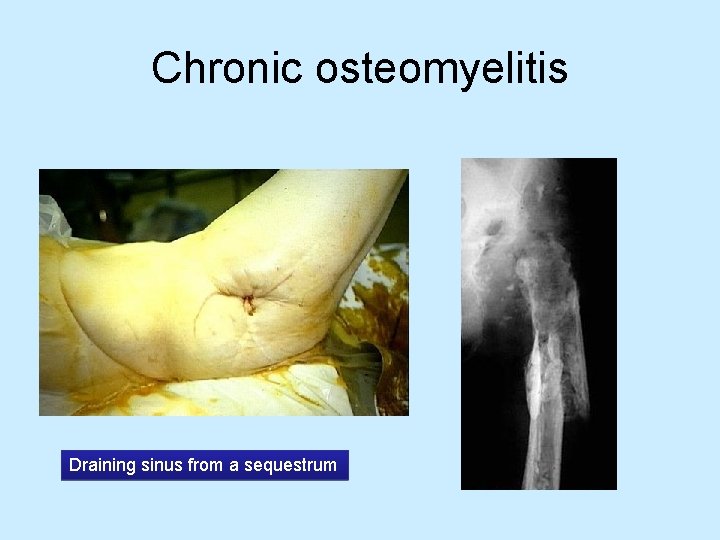 Chronic osteomyelitis Draining sinus from a sequestrum 