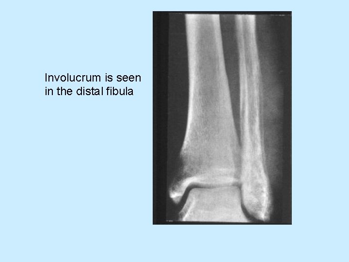 Involucrum is seen in the distal fibula 