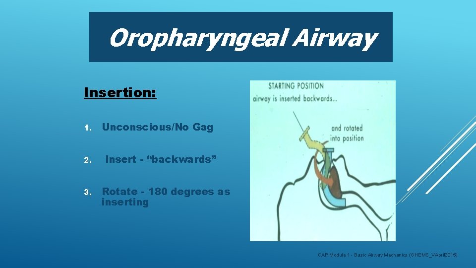 Oropharyngeal Airway Insertion: 1. Unconscious/No Gag 2. Insert - “backwards” 3. Rotate - 180