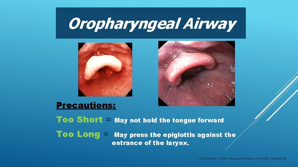 Oropharyngeal Airway Precautions: Too Short = Too Long = May not hold the tongue