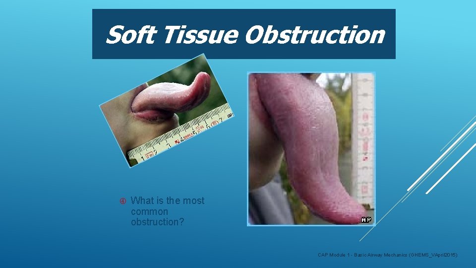 Soft Tissue Obstruction What is the most common obstruction? CAP Module 1 - Basic