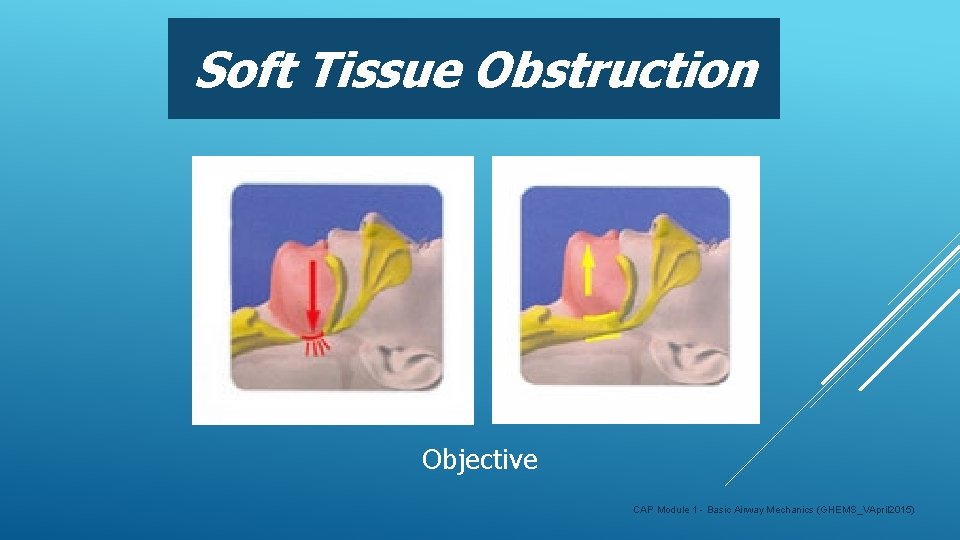 Soft Tissue Obstruction Objective CAP Module 1 - Basic Airway Mechanics (GHEMS_VApril 2015) 