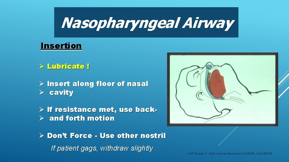 Nasopharyngeal Airway Insertion Ø Lubricate ! Ø Insert along floor of nasal Ø cavity