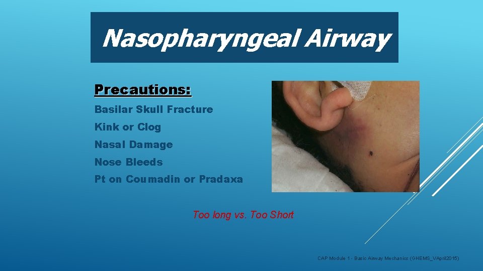 Nasopharyngeal Airway Precautions: Basilar Skull Fracture Kink or Clog Nasal Damage Nose Bleeds Pt