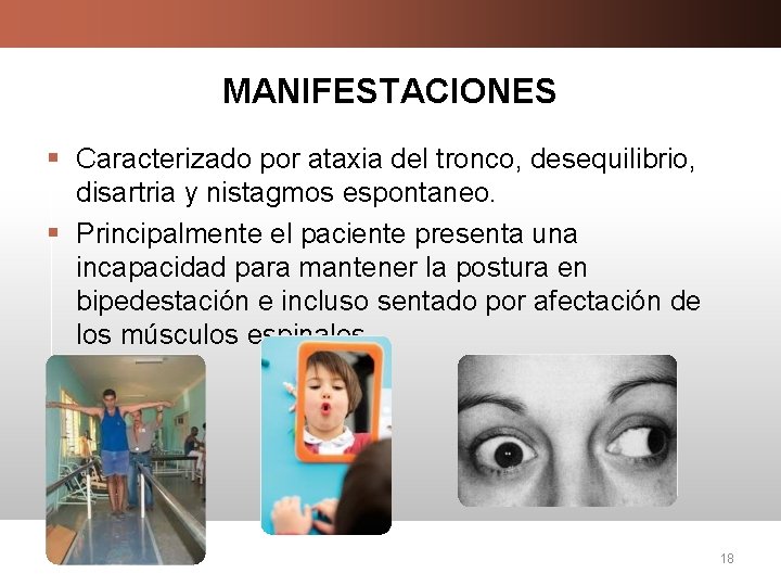 MANIFESTACIONES § Caracterizado por ataxia del tronco, desequilibrio, disartria y nistagmos espontaneo. § Principalmente