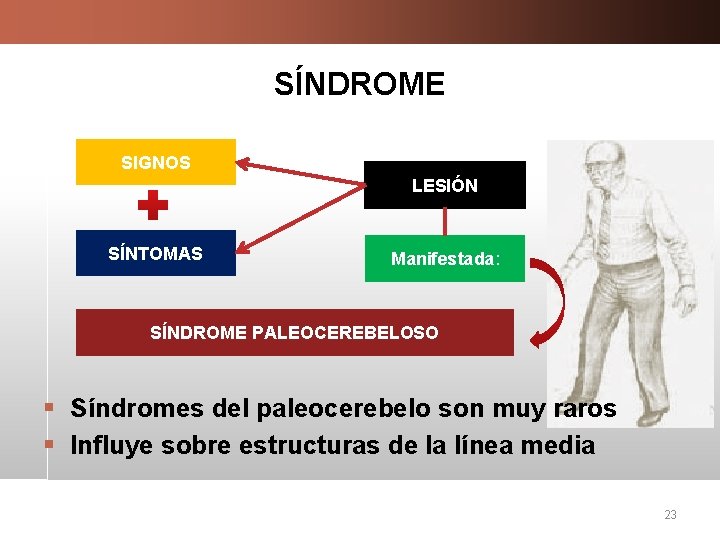 SÍNDROME SIGNOS LESIÓN SÍNTOMAS Manifestada: SÍNDROME PALEOCEREBELOSO § Síndromes del paleocerebelo son muy raros