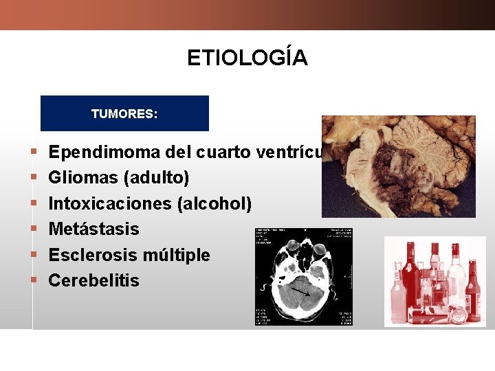 ETIOLOGÍA TUMORES: § § § Ependimoma del cuarto ventrículo Gliomas (adulto) Intoxicaciones (alcohol) Metástasis