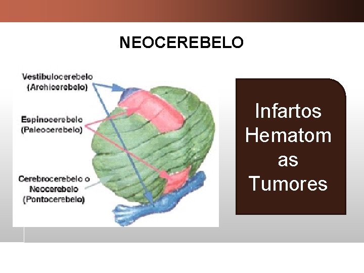 NEOCEREBELO Infartos Hematom as Tumores 