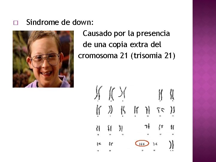 � � � Sindrome de down: Causado por la presencia de una copia extra