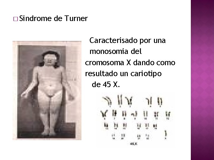 � Sindrome de Turner Caracterisado por una monosomia del cromosoma X dando como resultado