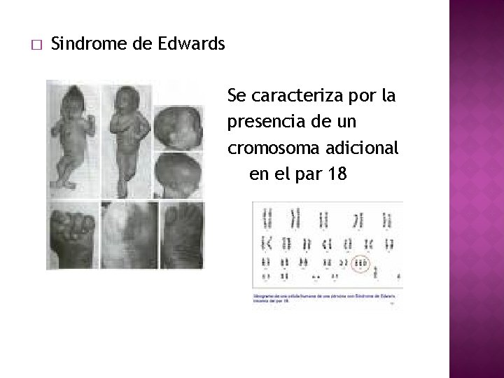 � Sindrome de Edwards Se caracteriza por la presencia de un cromosoma adicional en
