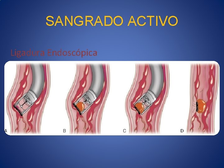 SANGRADO ACTIVO Ligadura Endoscópica 