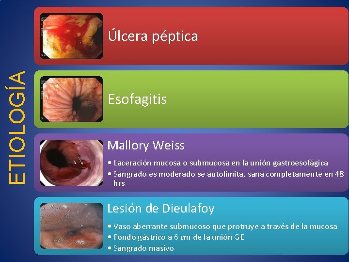 ETIOLOGÍA Úlcera péptica Esofagitis Mallory Weiss • Laceración mucosa o submucosa en la unión
