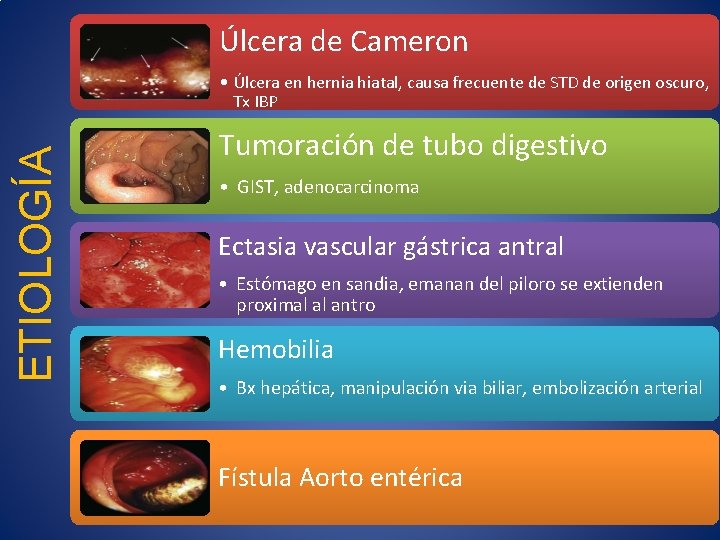 Úlcera de Cameron ETIOLOGÍA • Úlcera en hernia hiatal, causa frecuente de STD de